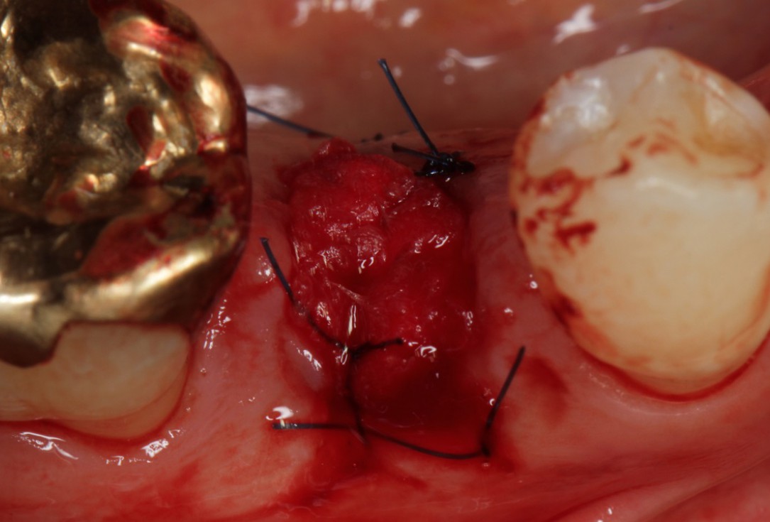 Socket seal with mucoderm® for later implant placement - Dr. Michael Back