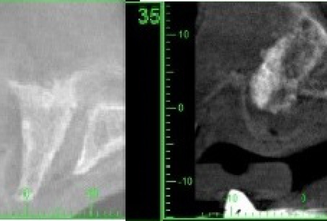 Reconstruction of maxillary ridge with maxgraft® block - Amit Patel