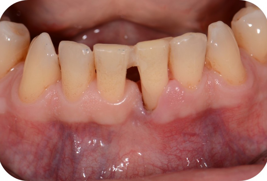 Two-wall intrabony defect treated using cerabone® and Straumann® Emdogain® - Rakasevic & Jankovic