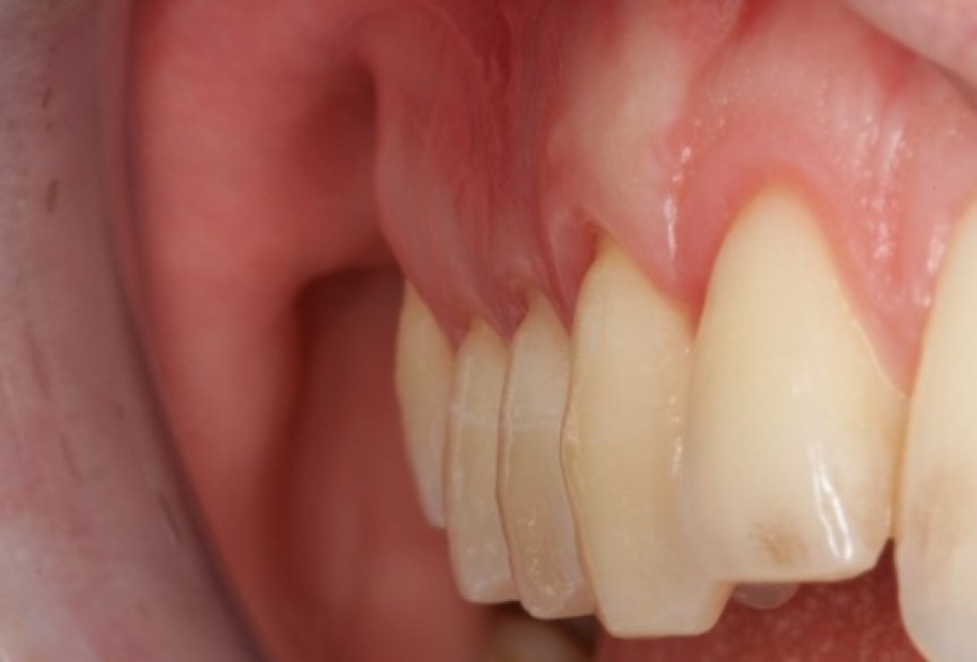 Multiple gingival recessions treated by CAF in conjunction with mucoderm® and Straumann® Emdogain® - Kasaj