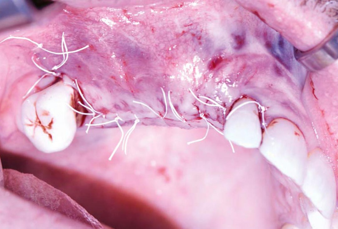 Ridge augmentation with maxgraft® bonebuilder and sinus floor elevation – Dr. K.P. Schiechl
