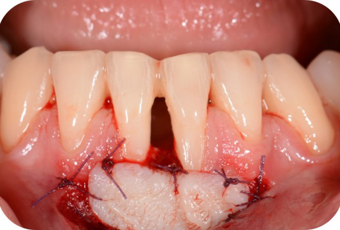 Two-wall intrabony defect treated using cerabone® and Straumann® Emdogain® - Rakasevic & Jankovic