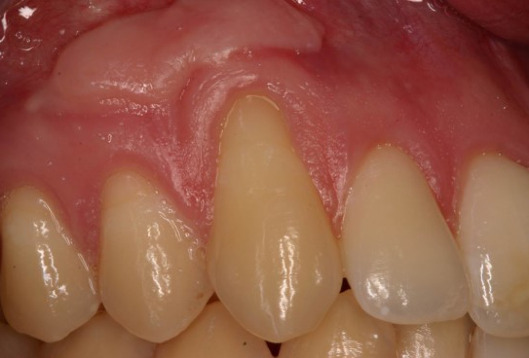 Single gingival recession treated with the envelope technique in conjunction with mucoderm® - Kasaj
