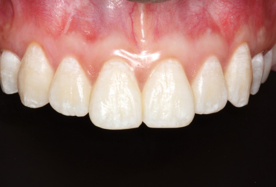 Isolated gingival recessions treated by CAF in conjunction with mucoderm® and Straumann® Emdogain® - Taba Jr