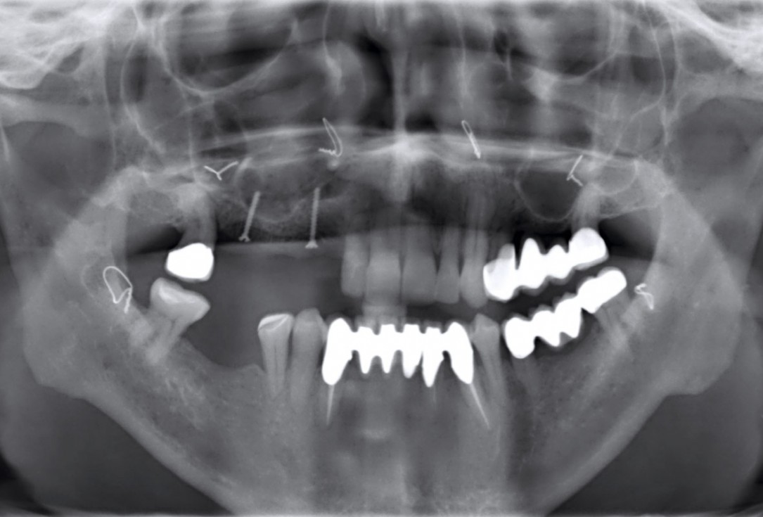 Ridge augmentation with maxgraft® bonebuilder and sinus floor elevation – Dr. K.P. Schiechl