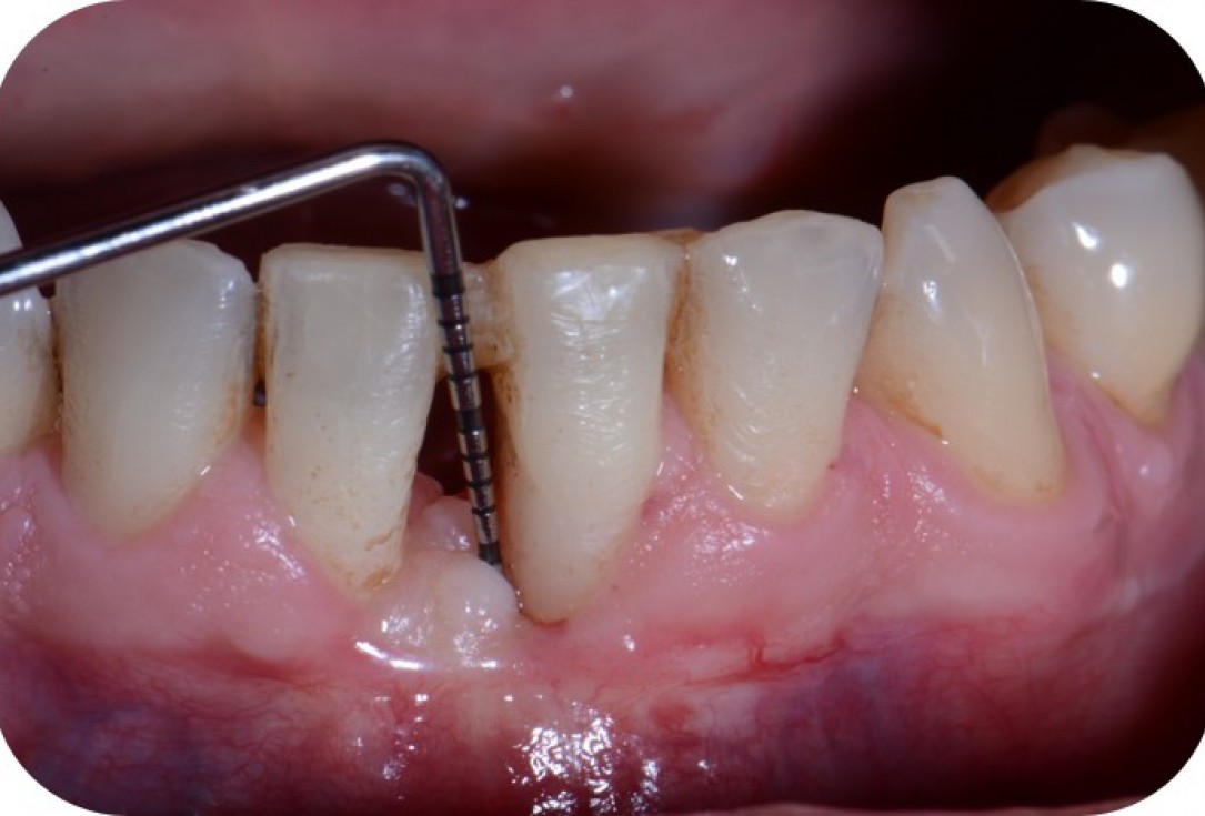 Two-wall intrabony defect treated using cerabone® and Straumann® Emdogain® - Rakasevic & Jankovic