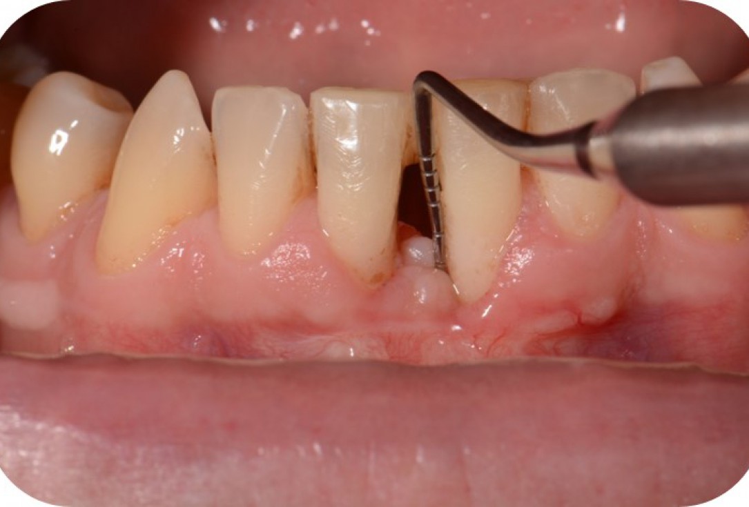 Two-wall intrabony defect treated using cerabone® and Straumann® Emdogain® - Rakasevic & Jankovic