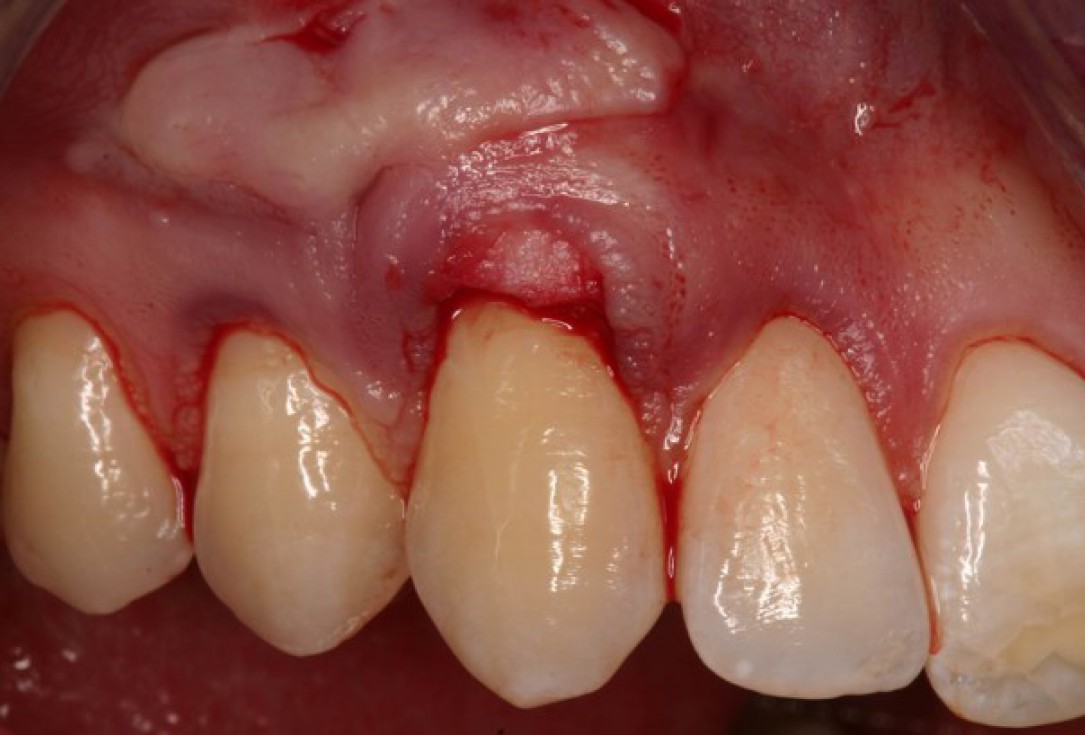 Single gingival recession treated with the envelope technique in conjunction with mucoderm® - Kasaj