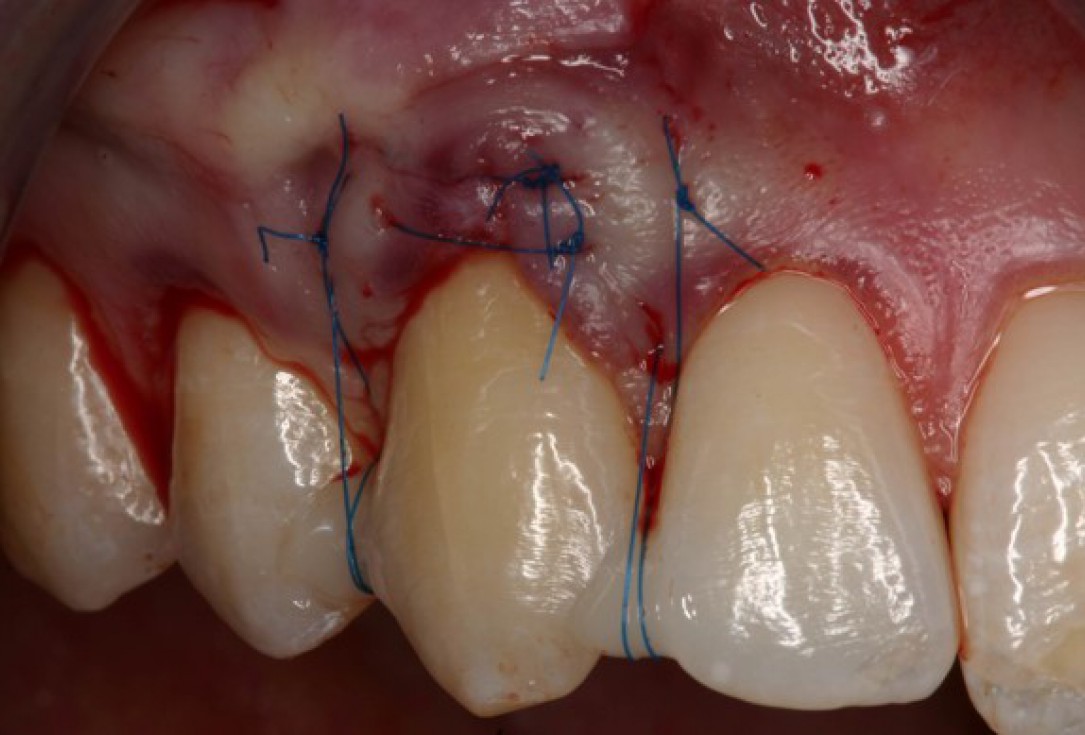 Single gingival recession treated with the envelope technique in conjunction with mucoderm® - Kasaj