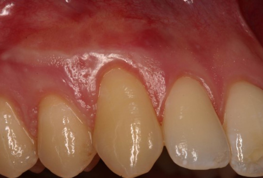 Single gingival recession treated with the envelope technique in conjunction with mucoderm® - Kasaj