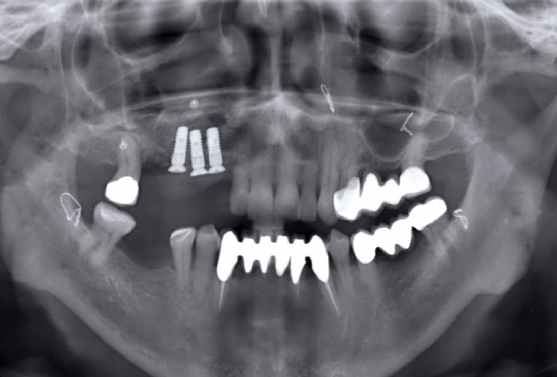 Ridge augmentation with maxgraft® bonebuilder and sinus floor elevation – Dr. K.P. Schiechl