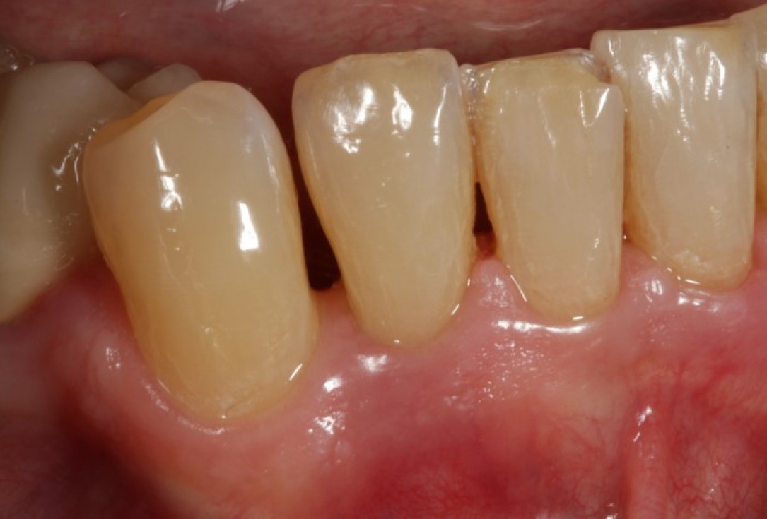 Non-contained intrabony defect treated using Straumann® Emdogain® and bone graft - Kasaj