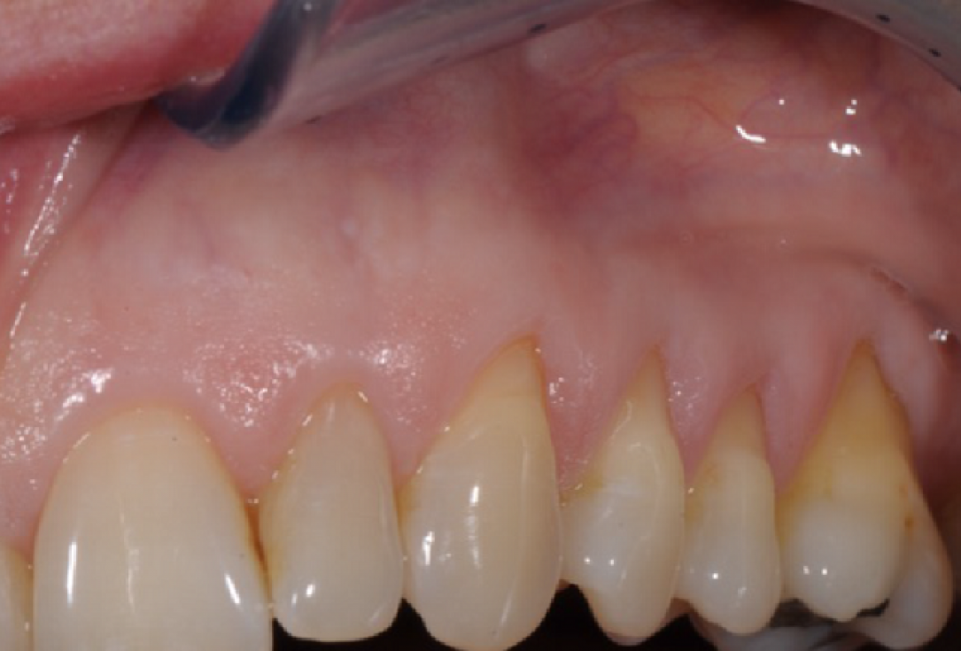 Multiple gingival recessions treated by MCAF in conjunction with mucoderm®, Straumann® Emdogain® and CTG - Benvenuto