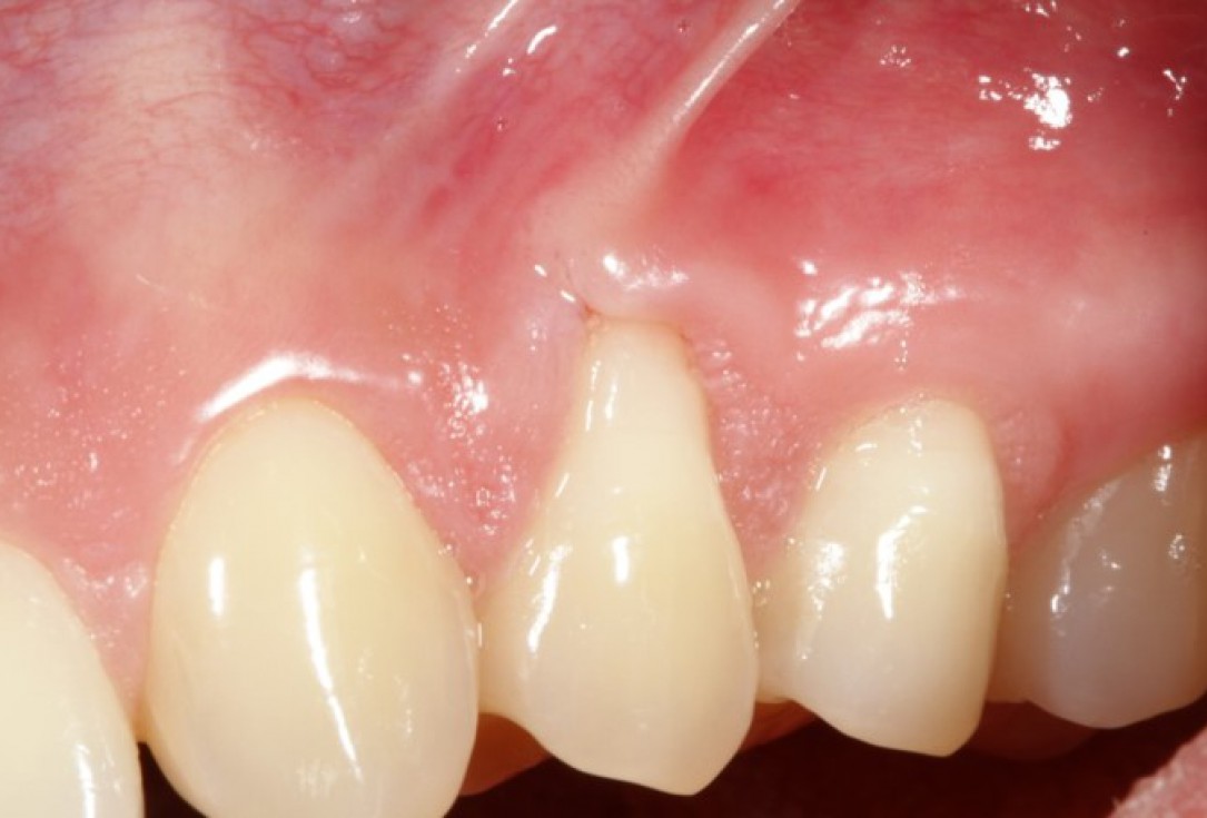 01/04 Single gingival recession treated by CAF in conjunction with mucoderm® - Kasaj