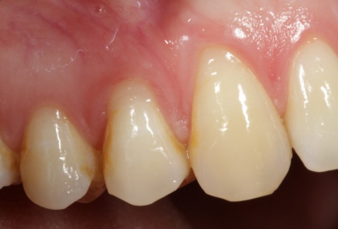 Multiple gingival recessions treated by CAF in conjunction with mucoderm® and Straumann® Emdogain® - Kasaj