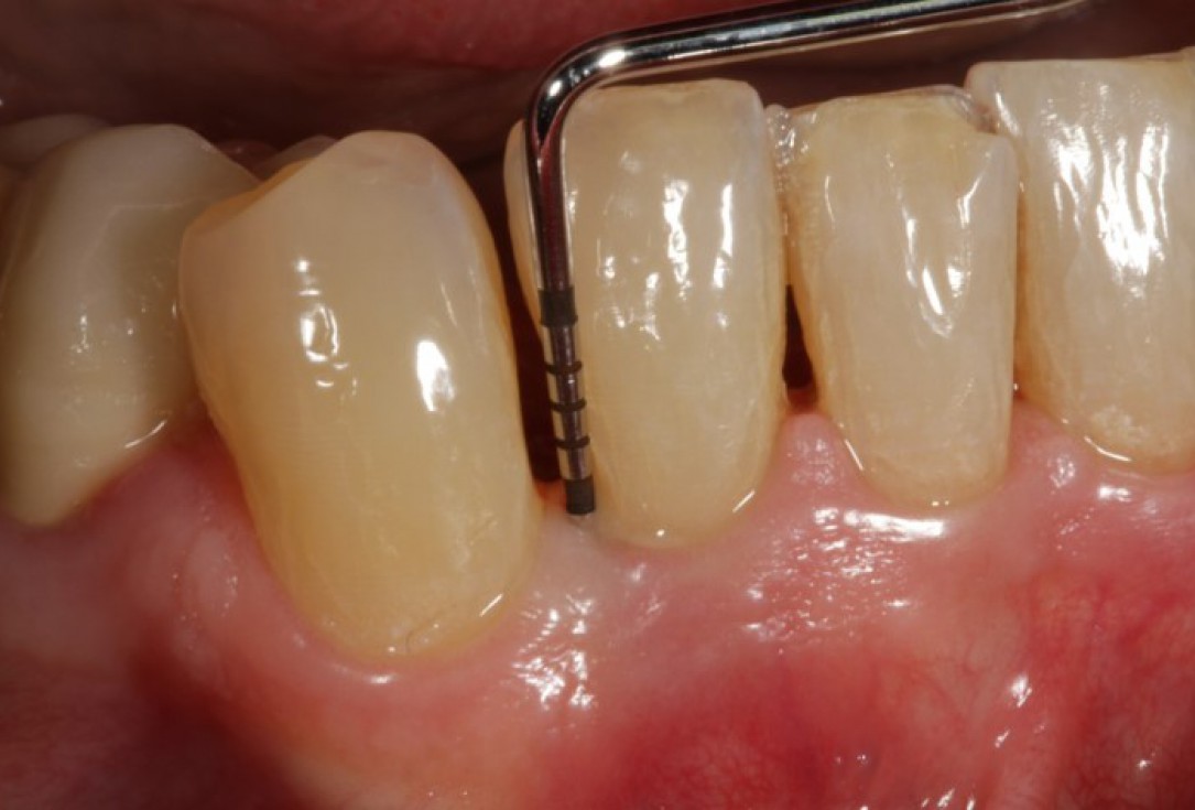 Non-contained intrabony defect treated using Straumann® Emdogain® and bone graft - Kasaj