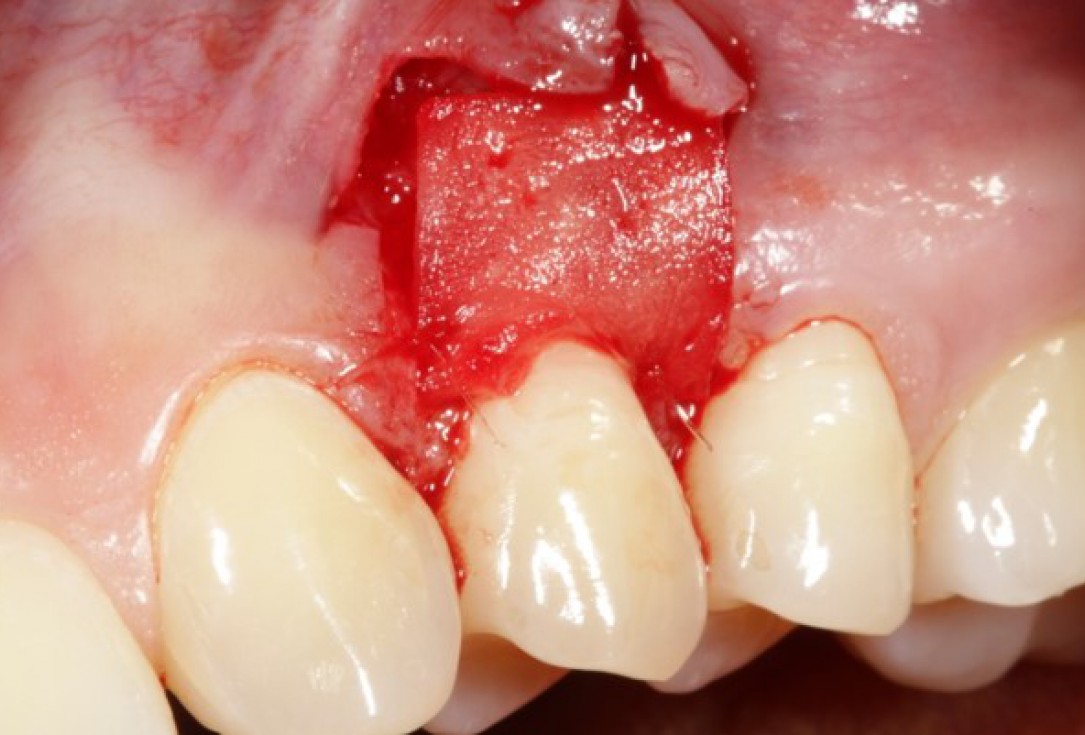 02/04 Single gingival recession treated by CAF in conjunction with mucoderm® - Kasaj
