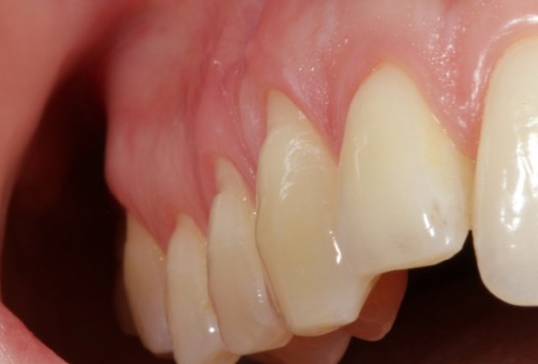 Multiple gingival recessions treated by CAF in conjunction with mucoderm® and Straumann® Emdogain® - Kasaj