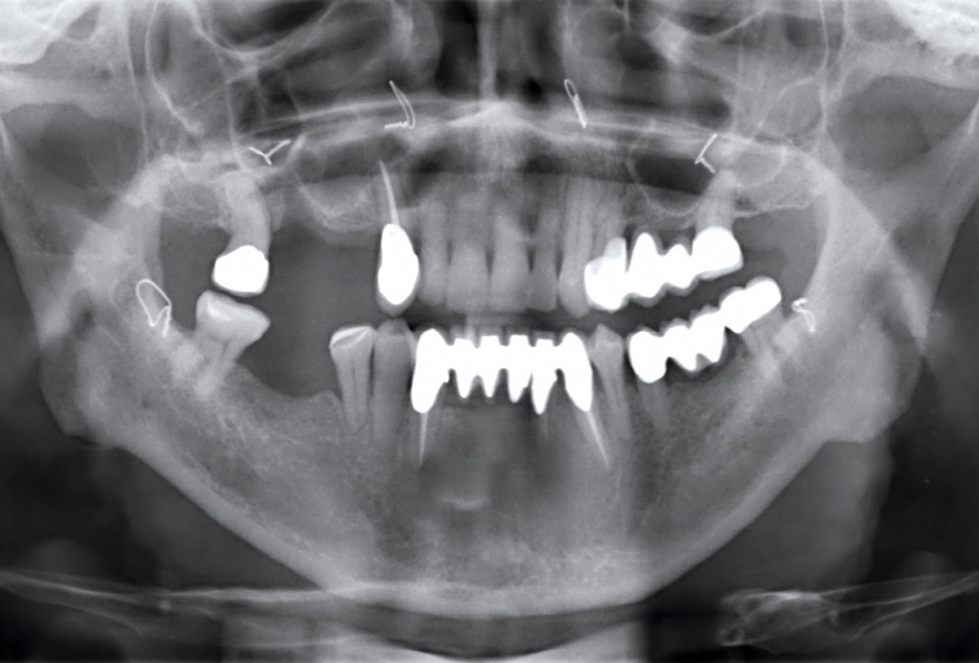 Ridge augmentation with maxgraft® bonebuilder and sinus floor elevation – Dr. K.P. Schiechl