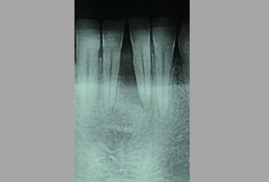 Two-wall intrabony defect treated using cerabone® and Straumann® Emdogain® - Rakasevic & Jankovic