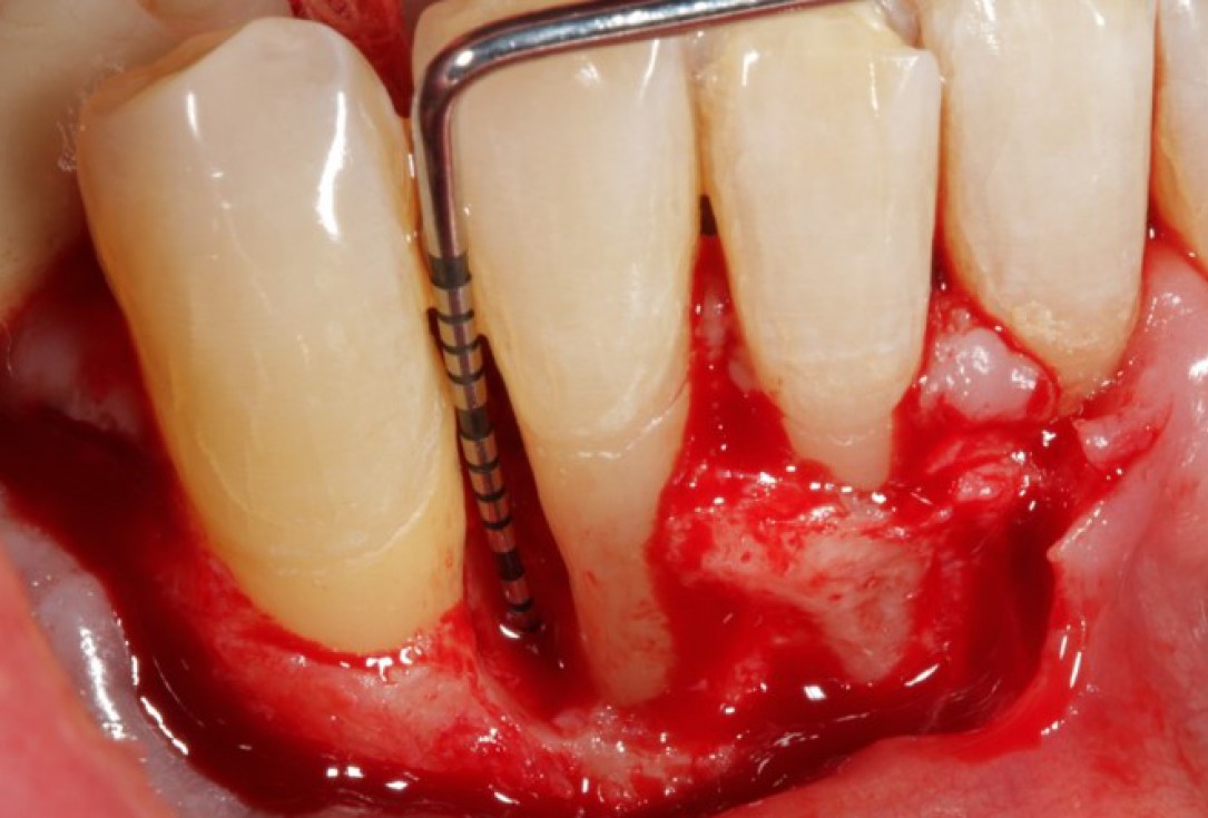 Non-contained intrabony defect treated using Straumann® Emdogain® and bone graft - Kasaj