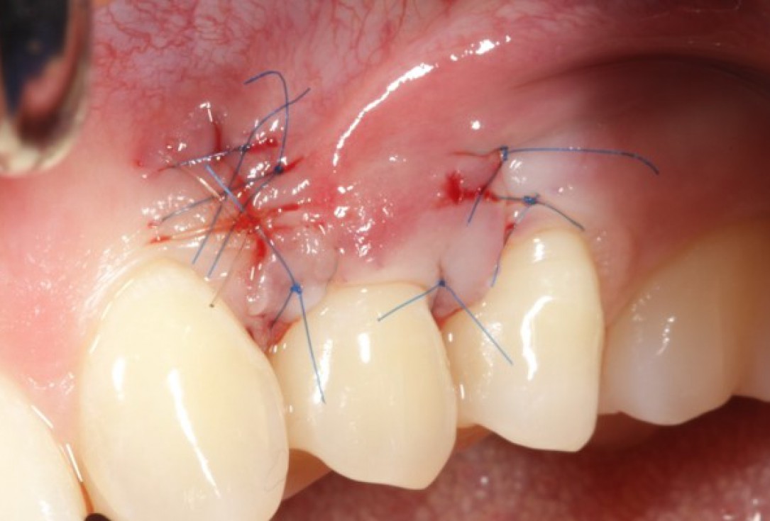 03/04 Single gingival recession treated by CAF in conjunction with mucoderm® - Kasaj