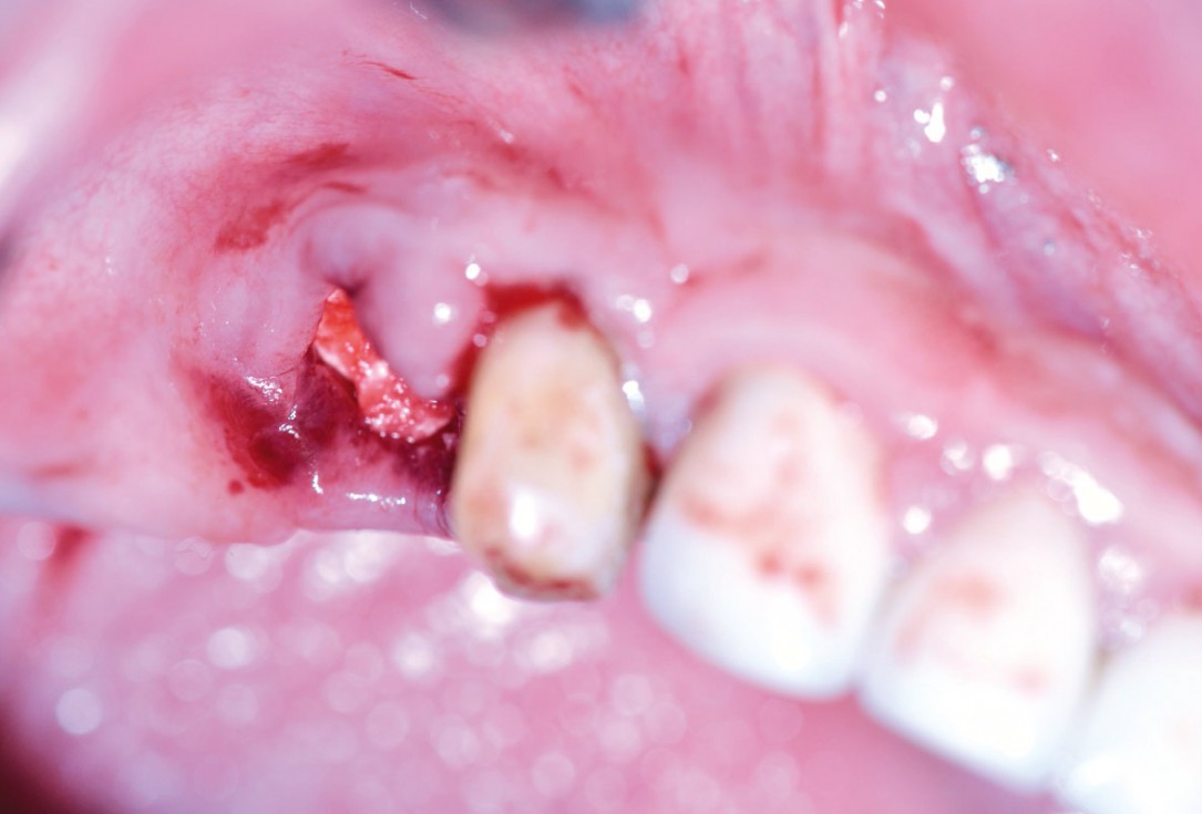 Ridge augmentation with maxgraft® bonebuilder and sinus floor elevation – Dr. K.P. Schiechl