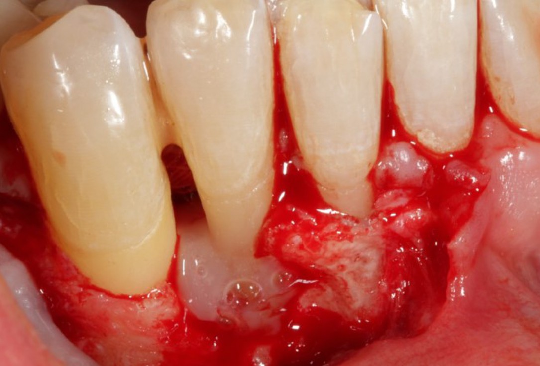 Non-contained intrabony defect treated using Straumann® Emdogain® and bone graft - Kasaj
