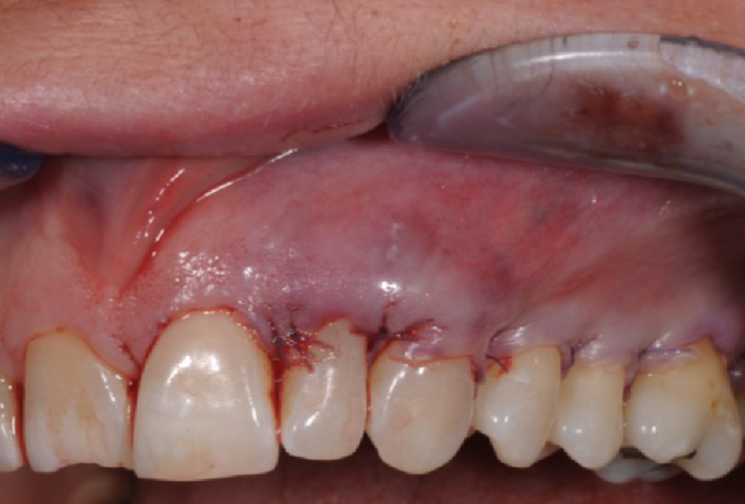Multiple gingival recessions treated by MCAF in conjunction with mucoderm®, Straumann® Emdogain® and CTG - Benvenuto