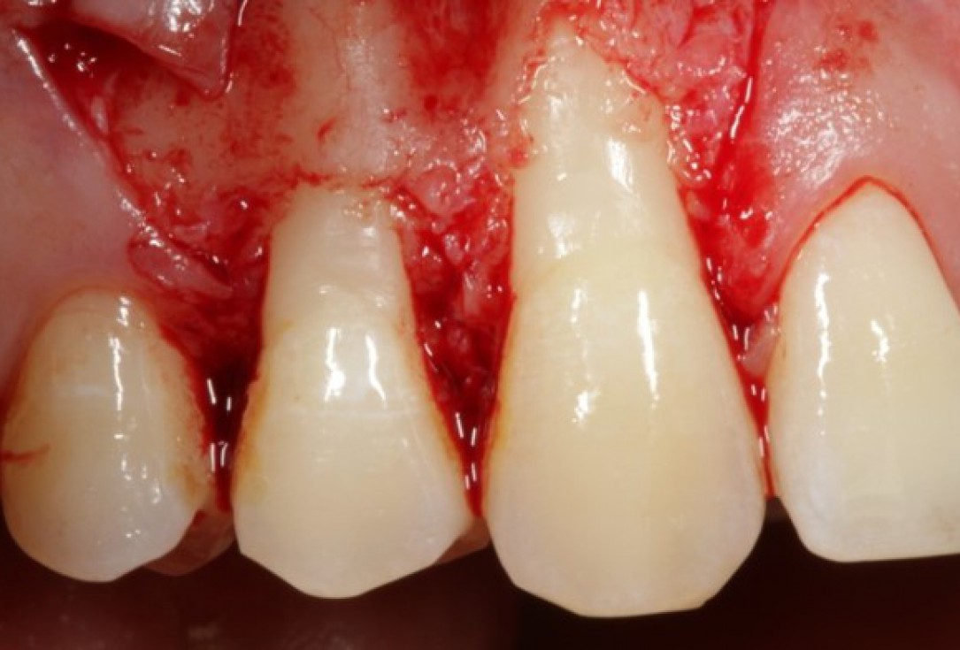 Multiple gingival recessions treated by CAF in conjunction with mucoderm® and Straumann® Emdogain® - Kasaj