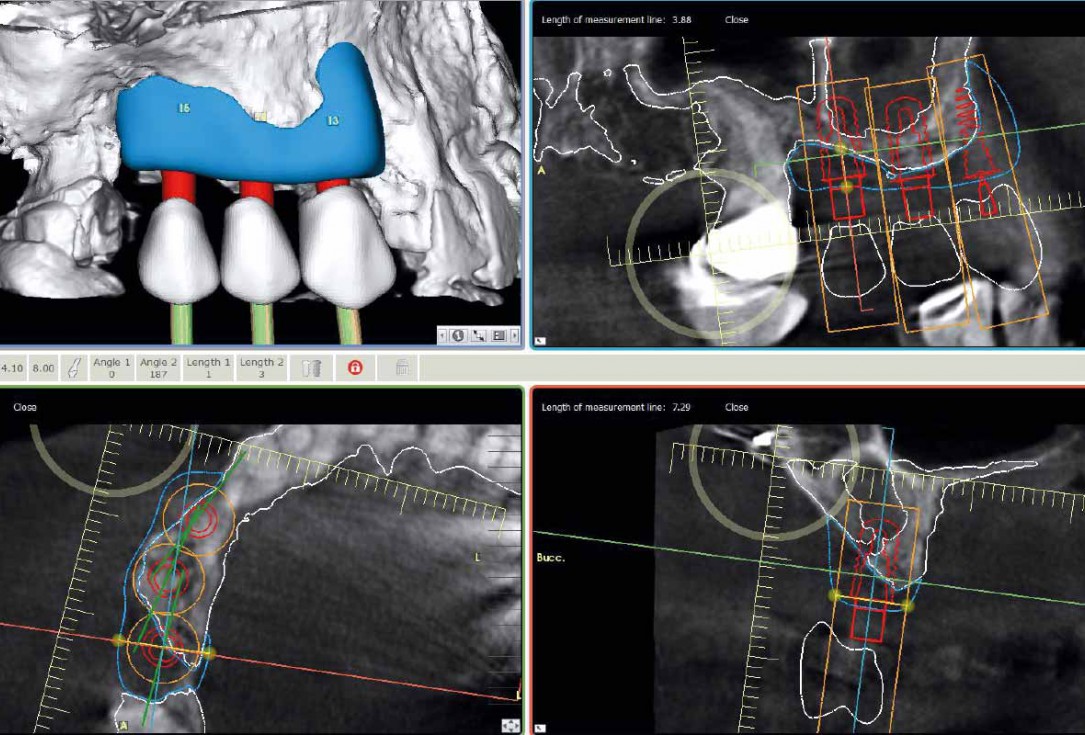 Ridge augmentation with maxgraft® bonebuilder and sinus floor elevation – Dr. K.P. Schiechl