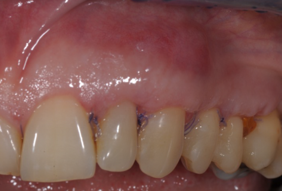 Multiple gingival recessions treated by MCAF in conjunction with mucoderm®, Straumann® Emdogain® and CTG - Benvenuto