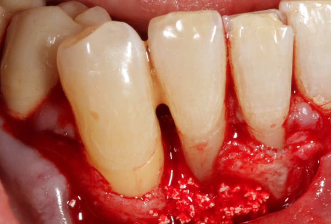 Non-contained intrabony defect treated using Straumann® Emdogain® and bone graft - Kasaj