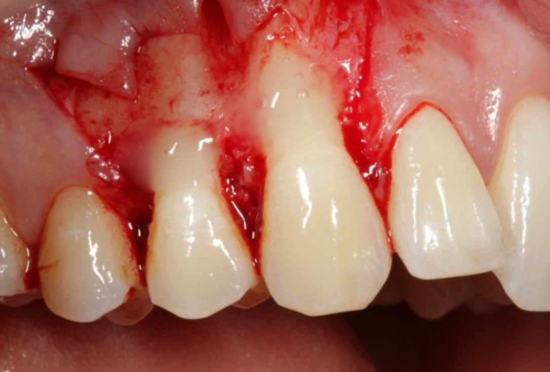 Multiple gingival recessions treated by CAF in conjunction with mucoderm® and Straumann® Emdogain® - Kasaj
