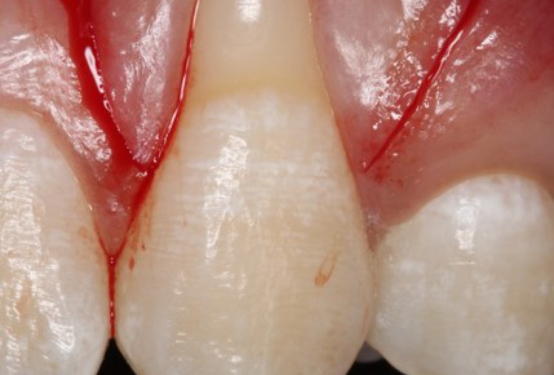 Isolated gingival recessions treated by CAF in conjunction with mucoderm® and Straumann® Emdogain® - Taba Jr