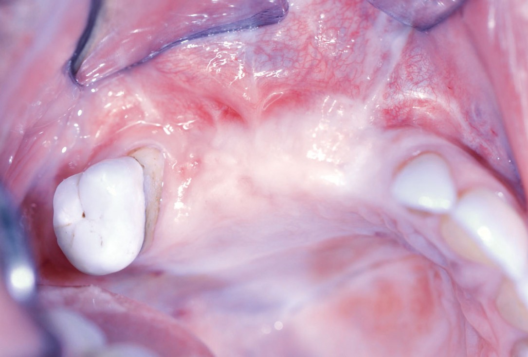 Ridge augmentation with maxgraft® bonebuilder and sinus floor elevation – Dr. K.P. Schiechl