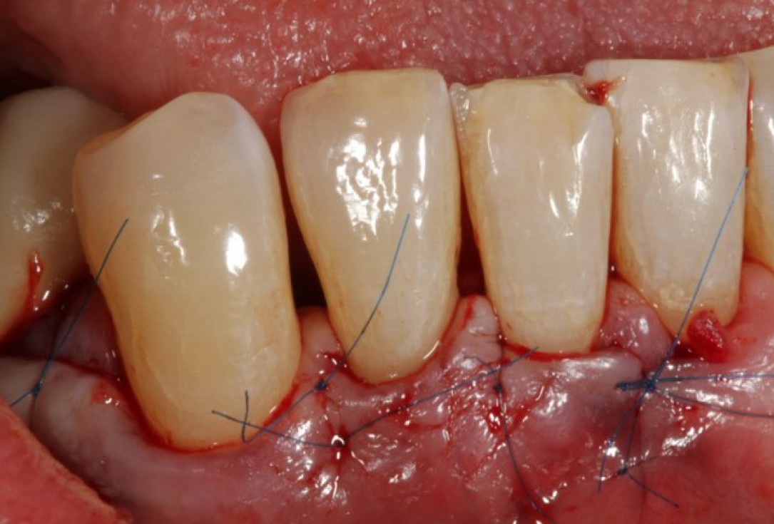 Non-contained intrabony defect treated using Straumann® Emdogain® and bone graft - Kasaj