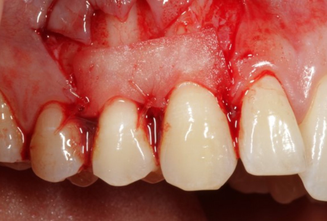 Multiple gingival recessions treated by CAF in conjunction with mucoderm® and Straumann® Emdogain® - Kasaj