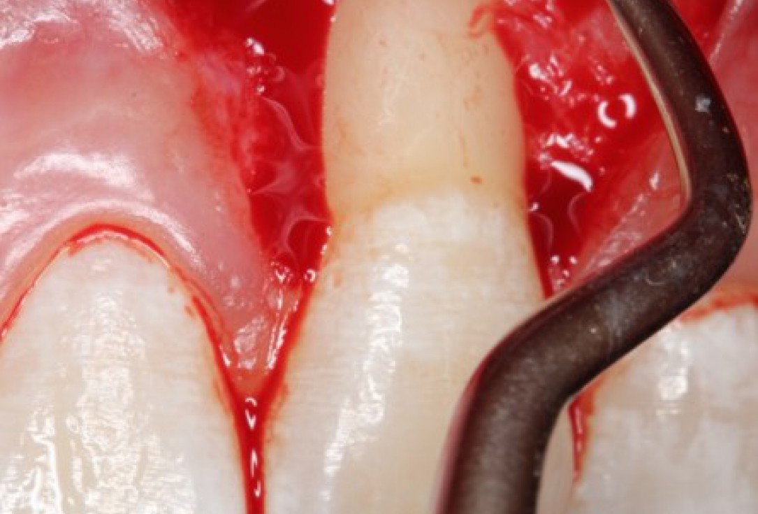 Isolated gingival recessions treated by CAF in conjunction with mucoderm® and Straumann® Emdogain® - Taba Jr