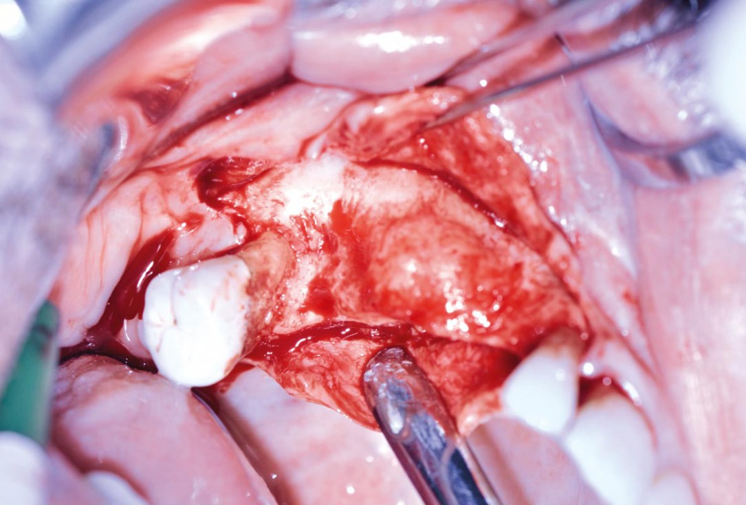 Ridge augmentation with maxgraft® bonebuilder and sinus floor elevation – Dr. K.P. Schiechl