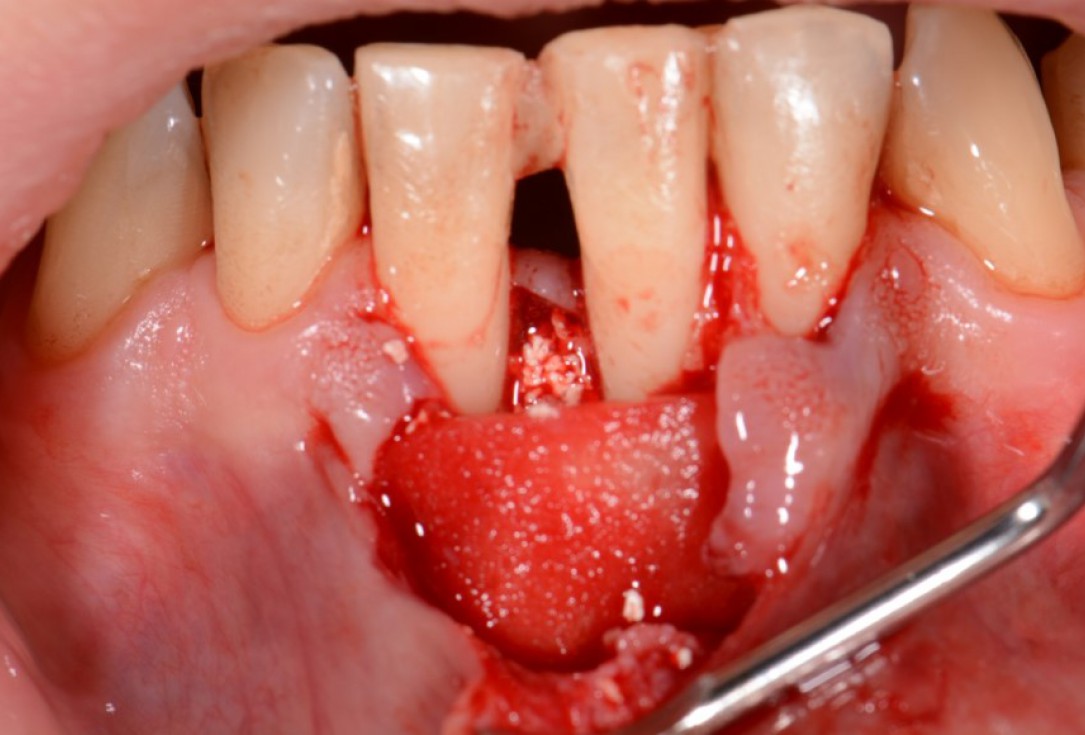 Two-wall intrabony defect treated using cerabone® and Straumann® Emdogain® - Rakasevic & Jankovic