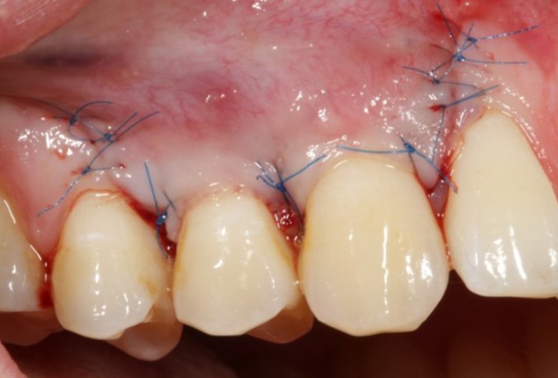 Multiple gingival recessions treated by CAF in conjunction with mucoderm® and Straumann® Emdogain® - Kasaj