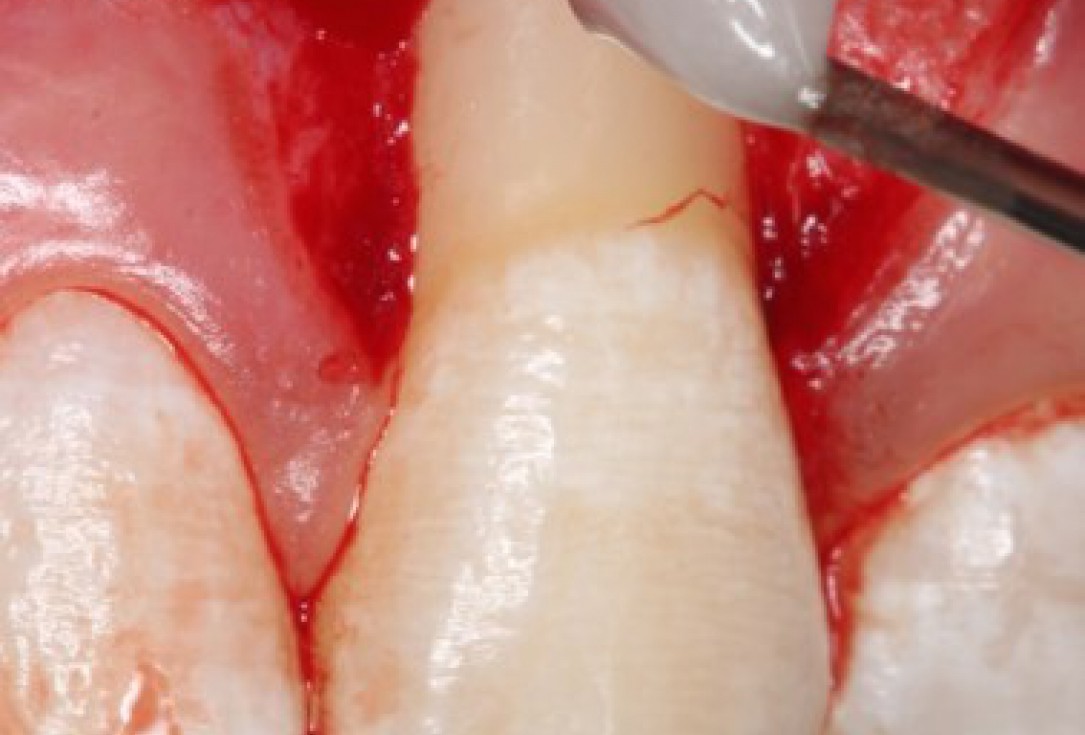 Isolated gingival recessions treated by CAF in conjunction with mucoderm® and Straumann® Emdogain® - Taba Jr