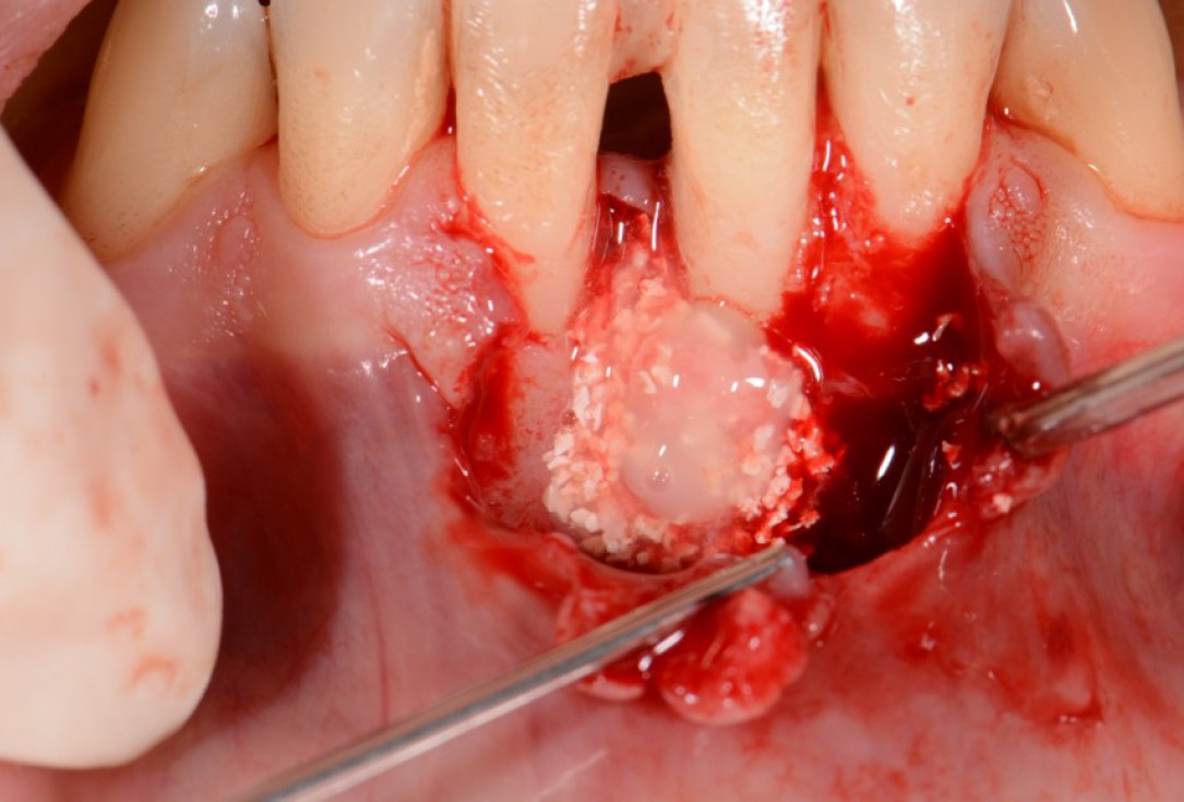 Two-wall intrabony defect treated using cerabone® and Straumann® Emdogain® - Rakasevic & Jankovic