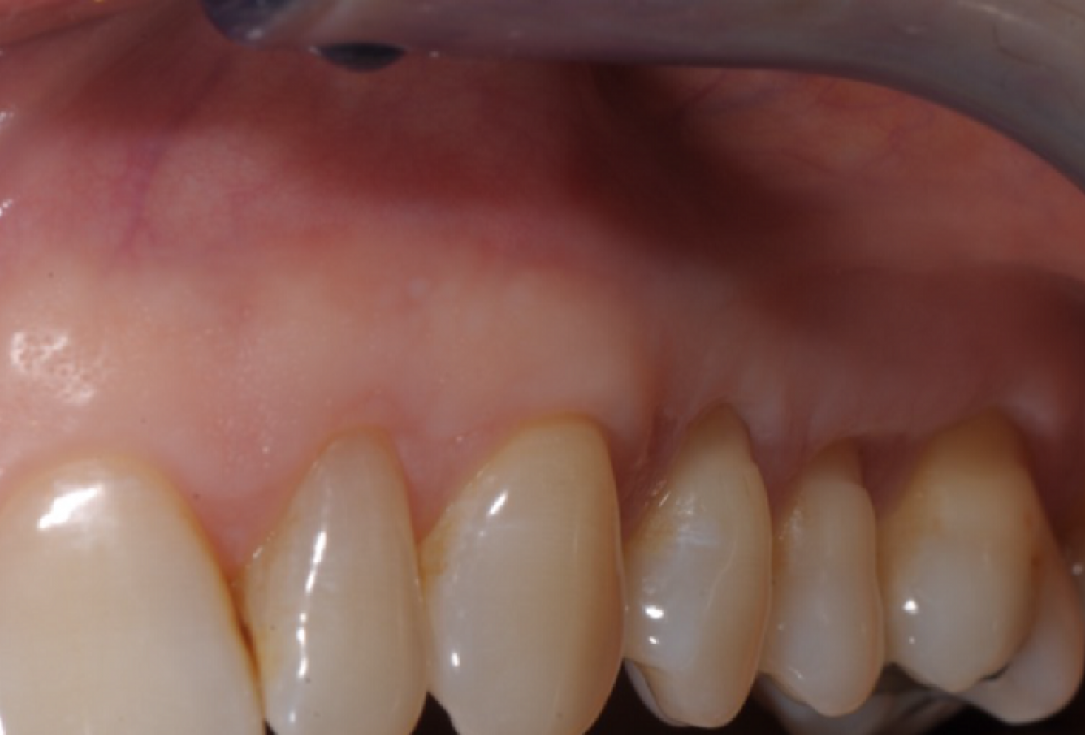 Multiple gingival recessions treated by MCAF in conjunction with mucoderm®, Straumann® Emdogain® and CTG - Benvenuto