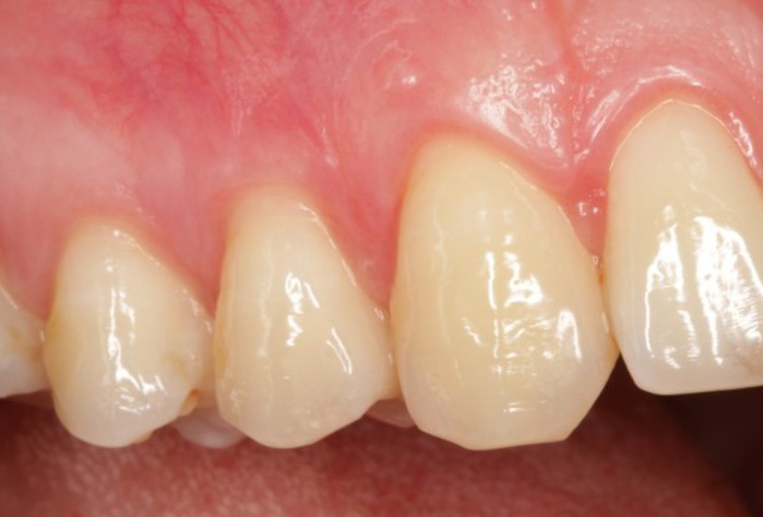 Multiple gingival recessions treated by CAF in conjunction with mucoderm® and Straumann® Emdogain® - Kasaj