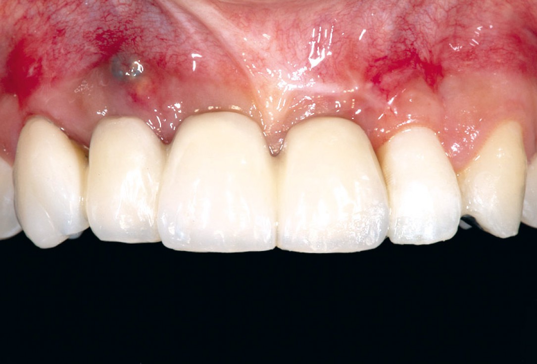 Block augmentation with maxgraft® block and mucoderm® - Dr. K. Chmielewski