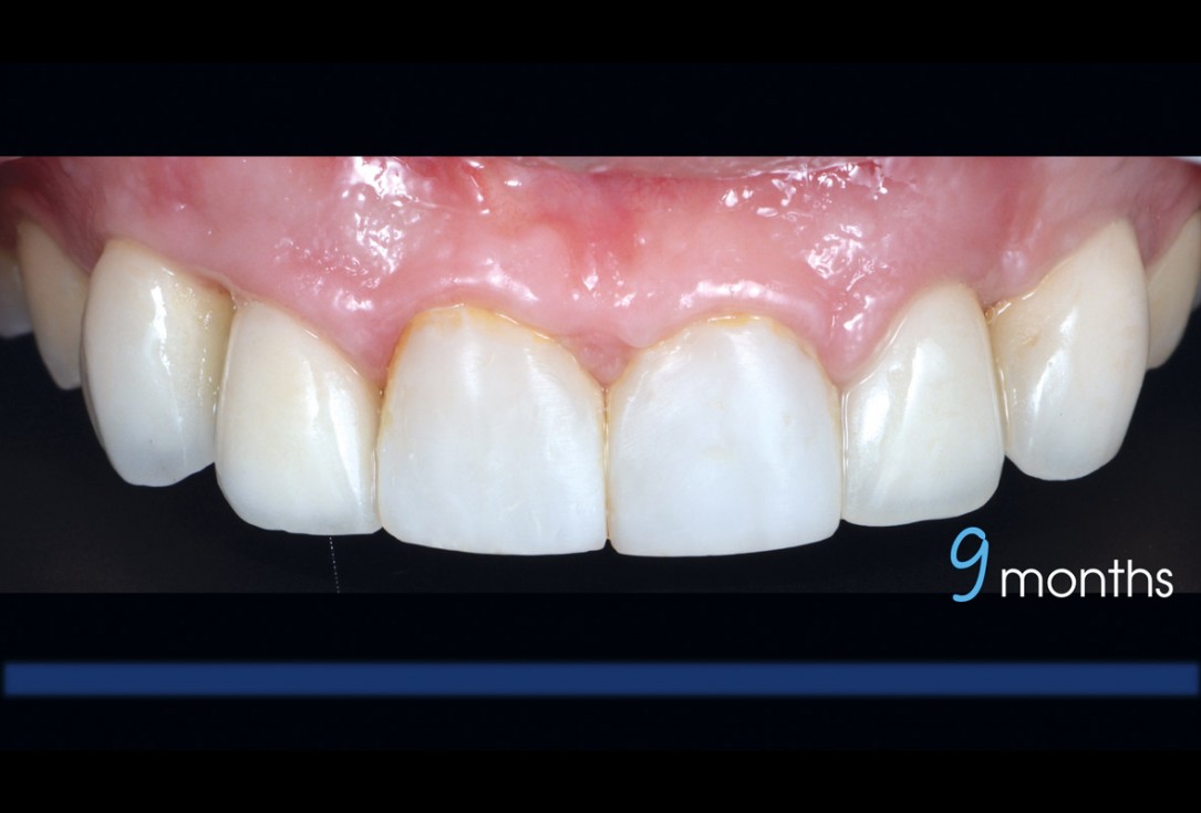 cerabone® and Jason® membrane for immediacy -Dr. M Motta