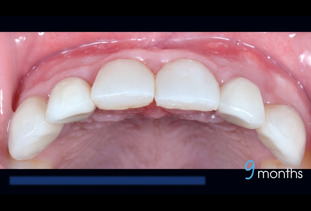 cerabone® and Jason® membrane for immediacy -Dr. M Motta