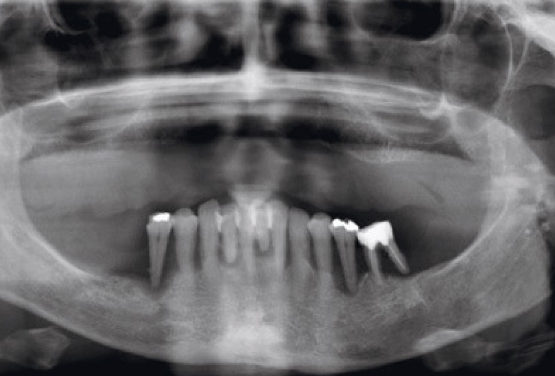 botiss maxresorb® inject for sinus lift - clinical case